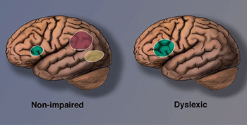 Differences between the dyslexia brain and the non-impaired brain

